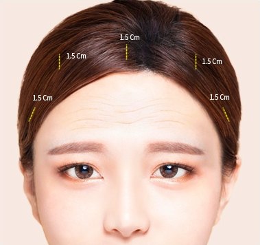 노란 점선으로 절개 위치 5곳과 1.5 Cm 치수가 표시된 이마·헤어라인 도해