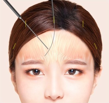 내시경 기구가 두피 안으로 들어가 박리하는 이마 도해
