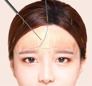 눈썹 위 근육 절개선이 분홍 실선으로 표시된 이마 도해