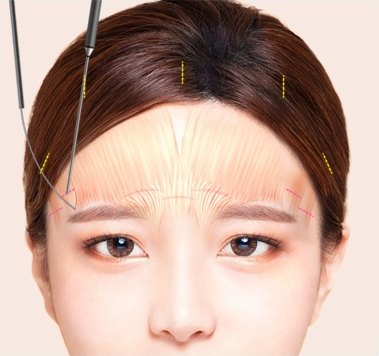 눈썹꼬리 인대조직을 기구로 풀어주는 이마 도해