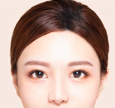 시술 후 이마 주름과 눈썹 처짐이 개선된 여성 정면 도해