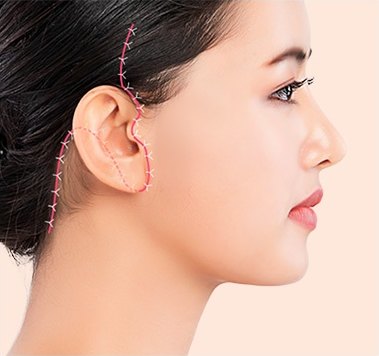 절개 부위 봉합 및 드레싱 — 귀 둘레를 따라 봉합선이 표시된 옆모습