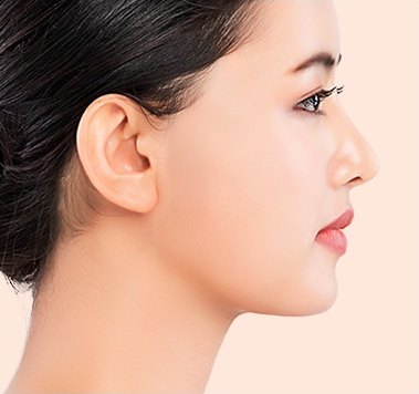 수술 후 — 처짐과 주름이 개선된 옆모습
