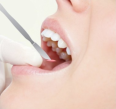 입안 점막에 기구를 대고 절개를 시작하는 구강 내 클로즈업