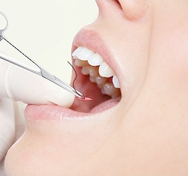 지침기와 바늘로 절개창을 봉합하는 구강 내 클로즈업