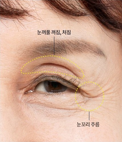 고령 여성의 눈가 초근접 사진 — 윗눈꺼풀 위에 노란 점선으로 '눈꺼풀 꺼짐, 처짐' 부위를, 눈꼬리에 '눈꼬리 주름' 부위를 표시했다.