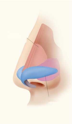 날개연골 박리 — 코뼈 및 윗코연골과 날개연골이 색으로 구분된 코 측면 단면 일러스트
