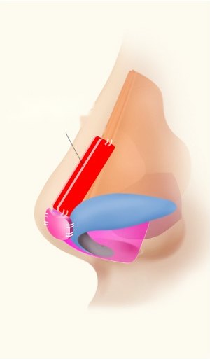 수술 후 — 펼침연골이식으로 아랫콧대를 높인 코 측면 단면 일러스트