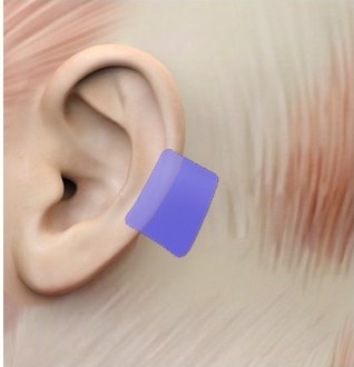 귀 뒤쪽 근막층 클로즈업에 채취 부위가 보라색으로 표시된 의학 일러스트