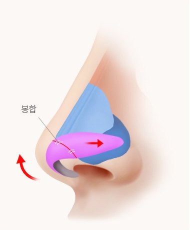 재봉합 단계 코 측면 해부 일러스트 — 봉합
