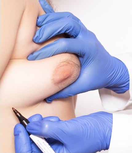 장갑을 낀 손이 유륜 부위를 잡고 수술용 마킹펜으로 절개 위치를 표시하는 클로즈업
