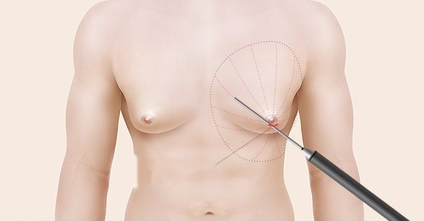 남성 상반신 의학 일러스트 — 가슴에 방사형 점선으로 시술 범위가 그려지고 유륜 아래로 흡입 캐뉼라가 삽입되어 있다