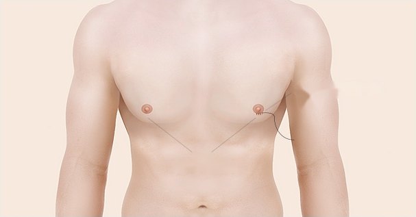 같은 남성 상반신 의학 일러스트 — 지방 제거 후 상태로 유륜에서 나온 지시선이 복부 중앙으로 모이고 봉합사 곡선이 그려져 있다