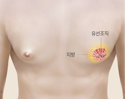 근육형 여유증 3D 의학 일러스트 — 얇은 지방 층 아래 그보다 큰 붉은 유선조직 덩어리가 표시되어 있다
