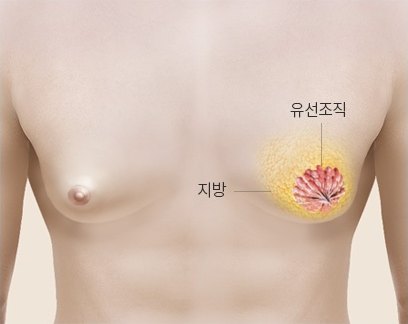 복합형 여유증 3D 의학 일러스트 — 지방 층과 붉은 유선조직이 비슷한 크기로 겹쳐 표시되어 있다
