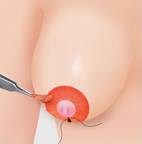 유륜 절개법 4단계 — 메스로 절개를 시행하는 단계