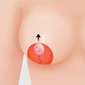 유륜 절개법 5단계 — 조직을 제거하고 유륜을 위로 이동
