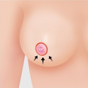 유륜 절개법 6단계 — 절개창을 모으는 방향 표시