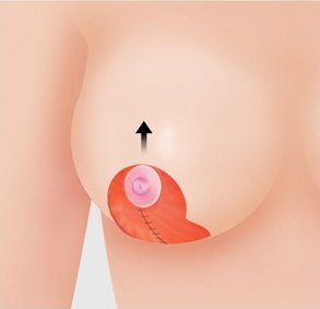 수직 절개법 5단계 — 조직을 제거하고 유륜을 위로 이동
