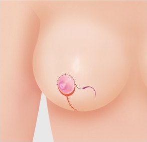 수직 절개법 7단계 — 봉합을 마친 수직 봉합선