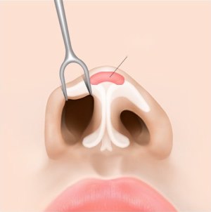 비개방형 절개 수술 3단계 — 실리콘 보형물로 콧대와 코끝을 높이는 일러스트