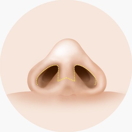 개방형 절개 — 코 아랫면에서 올려다본 일러스트로 양쪽 콧구멍 테두리와 그 사이 비주(콧기둥)를 가로지르는 절개선이 표시되어 있다
