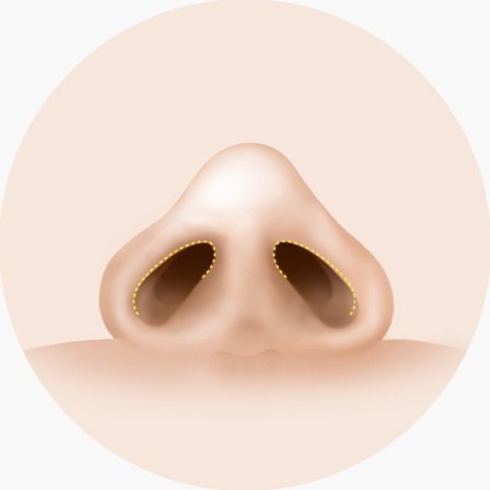 비개방형 절개 — 같은 코 아랫면 일러스트이지만 절개선이 좌우 콧구멍 안쪽 테두리를 따라서만 이어지고 비주는 가로지르지 않는다