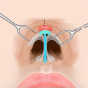 개방형 절개 수술 3단계 — 실리콘 보형물과 귀연골을 콧대·코끝·비주 지지대에 삽입하는 일러스트