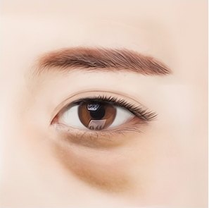 중년 여성의 한쪽 눈 주위를 클로즈업한 의학 일러스트 — 처진 윗눈꺼풀과 눈 밑 꺼짐이 보인다