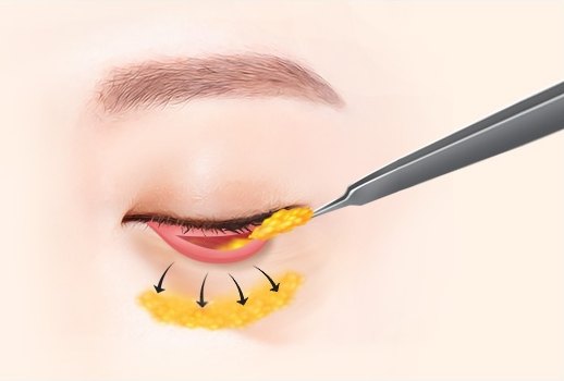 눈밑지방재배치를 묘사한 눈 일러스트 — 은색 기구가 결막쪽 노란 지방을 집어 올리고 검은 화살표가 재배치 방향을 가리킨다