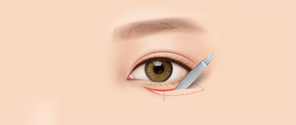 여성 한쪽 눈을 정밀 묘사한 일러스트에 수술용 메스 날이 아래 속눈썹 라인으로 들어오고 절개 예정 부위가 빨간 실선과 점선으로 표시된 그림