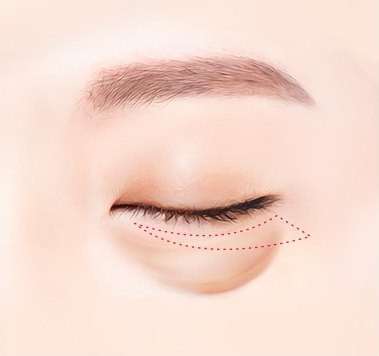 절개선 디자인 단계 — 눈을 감은 눈 부위에 아래 속눈썹 라인을 따라 빨간 점선이 표시된 일러스트