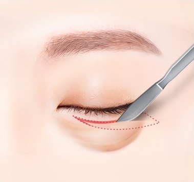 절개 단계 — 은색 메스가 아래 속눈썹 라인을 절개하고 절개 부위가 빨간 선으로 표시된 일러스트