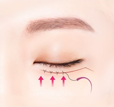 봉합 단계 — 아래 속눈썹 라인을 따라 봉합 매듭이 이어지고 분홍 화살표가 피부를 위로 당기는 방향을 가리키는 일러스트
