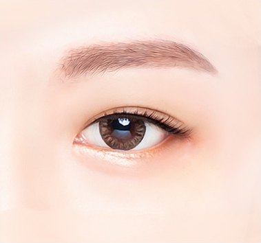 수술 후 상태 — 눈을 뜬 눈 부위 클로즈업, 눈 밑 볼록함과 주름이 사라져 매끈하다