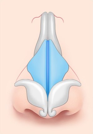 수술 전 — 날개 연골이 넓게 벌어진 코의 해부 일러스트