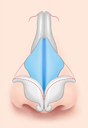 연골 절제 — 날개 연골 끝부분의 절제 범위를 빨간 점선으로 표시한 일러스트