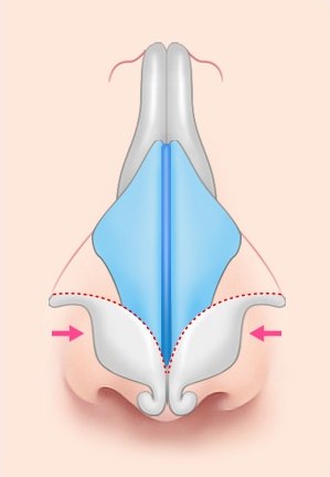 연골 모아줌 — 좌우에서 안쪽으로 연골을 모으는 방향을 분홍 화살표로 표시한 일러스트