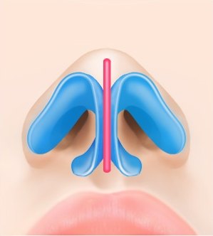 지지대 보강 — 콧대 중앙에 분홍색 세로 지지대를 세운 일러스트