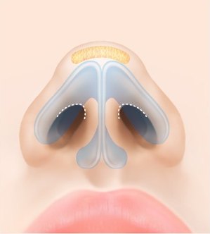 절개 — 콧구멍 안쪽 절개선을 흰 점선으로 표시한 일러스트