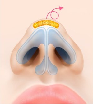 코끝 지방 제거 — 노란색으로 강조된 코끝 지방층과 제거 방향을 나타내는 분홍 화살표