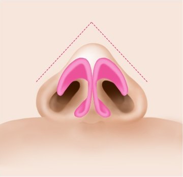 일반적인 코끝(Normal tip) 해부 일러스트 — 분홍색 비익연골 위에 삼각형 점선 가이드