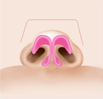 퍼진 상자 코끝(Boxy tip) 해부 일러스트 — 사각 대괄호형 점선 가이드