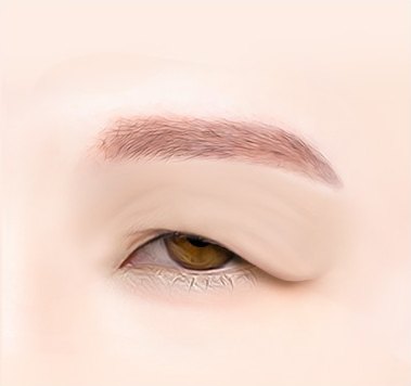 눈썹위거상술 수술 전 — 처지고 주름진 눈꺼풀을 그린 의학 일러스트