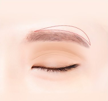 눈썹 밑 절개 디자인 — 이마 피부에 붉은 점선으로 절개 예정선을 아치형으로 그린 의학 일러스트