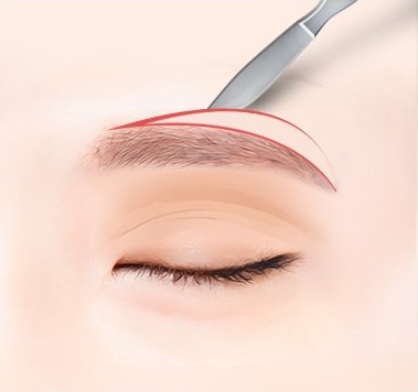 눈썹 아래 절개 — 은색 메스가 사선으로 들어와 눈썹 밑을 절개하는 의학 일러스트