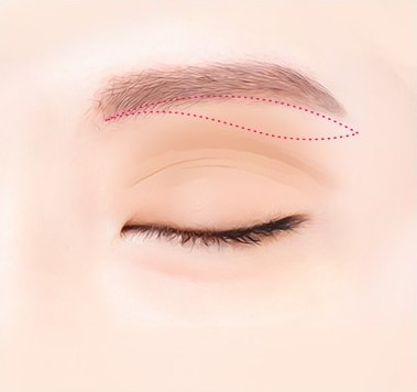 눈썹 밑 절개 디자인 — 감은 눈의 눈썹 아래에 분홍색 점선으로 절개선을 그린 일러스트