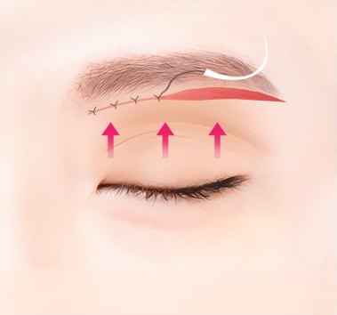섬세 봉합 — 눈썹선을 따라 가는 실로 봉합하고 피부가 위로 당겨 올라감을 화살표로 표시한 일러스트