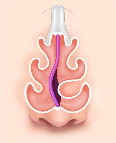 C형 비중격 만곡증 해부 일러스트 — 비중격 아래쪽이 C자로 휘어 한쪽 비강이 좁아진 코 내부 단면