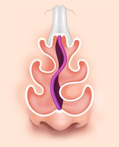 S형 비중격 만곡증 해부 일러스트 — 비중격이 상·하 양방향으로 휘어 S자를 그리는 코 내부 단면